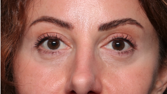 Blepharoplasty and Brow Lift Before & After Patient #34363